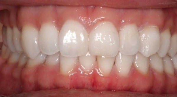 After - Campden House Dental