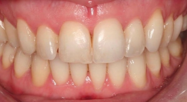 After - Campden House Dental