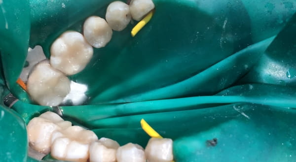 After - Campden House Dental