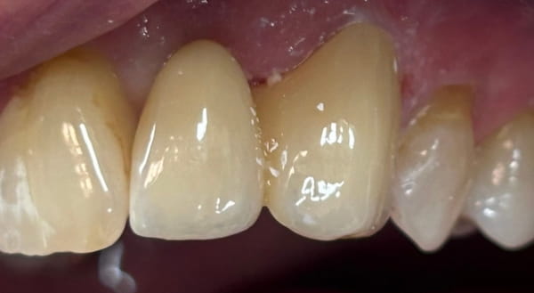 After - Campden House Dental