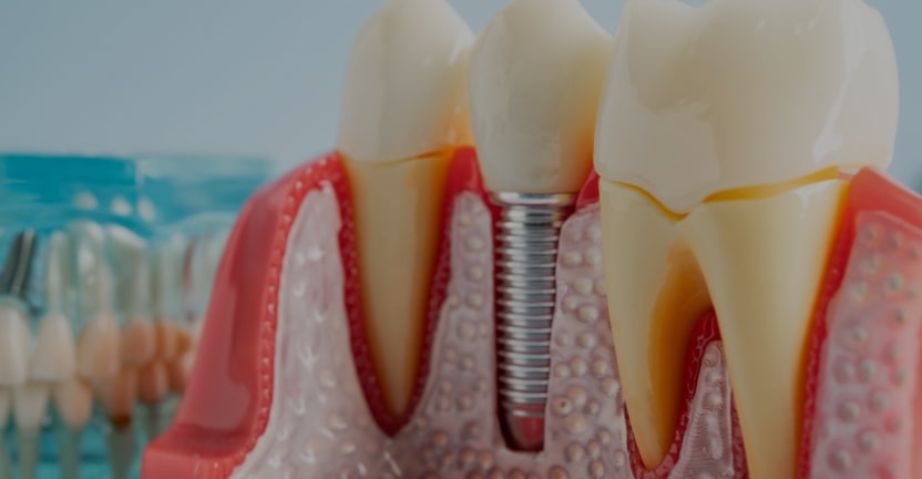 Treatments - Campden House Dental